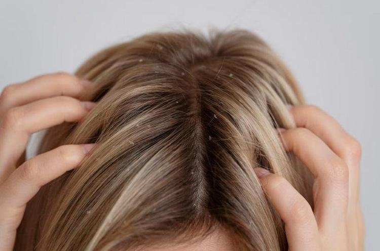 Mulher com problemas de caspa