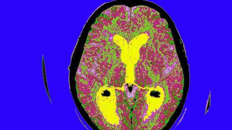 Crebro de paciente de Alzheimer
