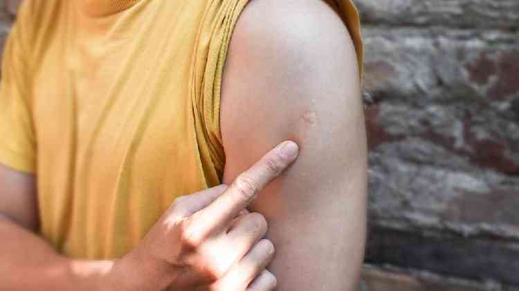 Pessoa mostrando marca da vacina BCG no seu brao