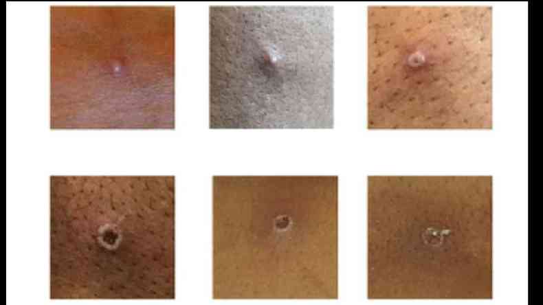 Seis imagens de peles com pequenas feridas de varola