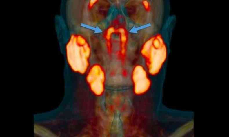 As novas glndulas ficam atrs do nariz, no encontro com a garganta(foto: VALSTAR, ET. AL./RADIOTHERAPY AND ONCOLOGY)