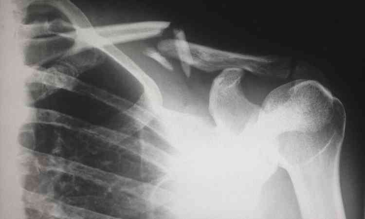 radiografia em que aparece osso do brao e costelas