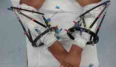 Hospital da Baleia faz cirurgia inovadora em jovem com pernas arqueadas 