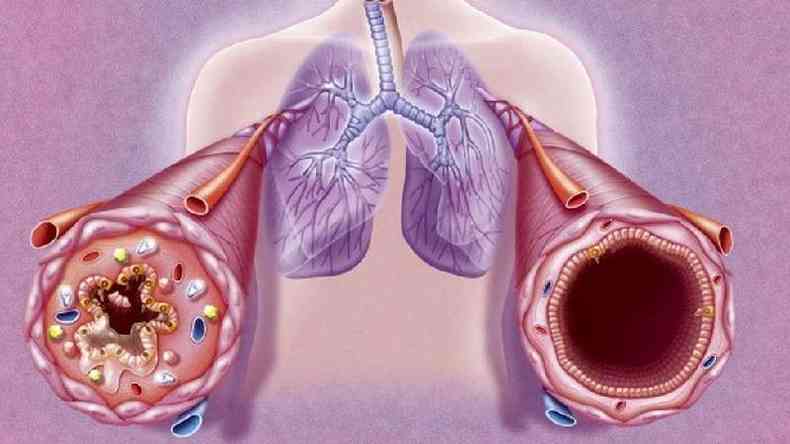 A asma  uma doena crnica em que os brnquios, tubos por onde o ar passa, sofrem com inflamaes e podem fechar (como ilustrado  esquerda) durante as crises. Isso causa falta de ar e outras complicaes(foto: Getty Images)