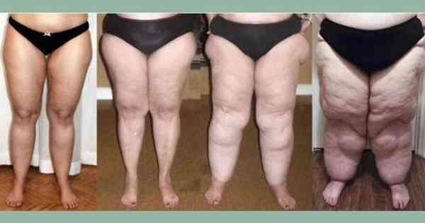 Lipedema, you know what?  Discover the impact on women’s lives – SAD