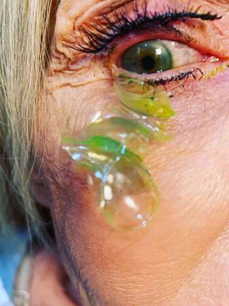 Paciente que esteva com 23 lentes de contato dentro do olho 