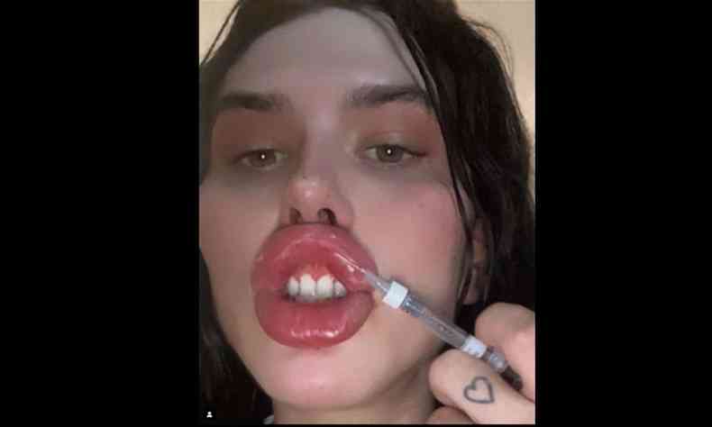 Sofia Lips aplicando preenchimento labial