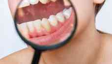 Hiperdontia: entenda condio que causa desenvolvimento de dentes extras