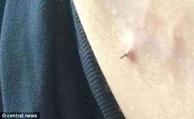 A agulha cirrgica apareceu de dentro para fora(foto: Daily Mail/Reproduo)