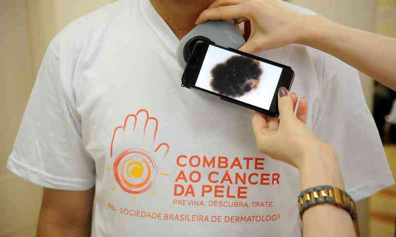 Homem com camiseta da campanha de preveno ao cncer de pele  examinado e aparelho mostra mancha indicando a deteco de um melanoma