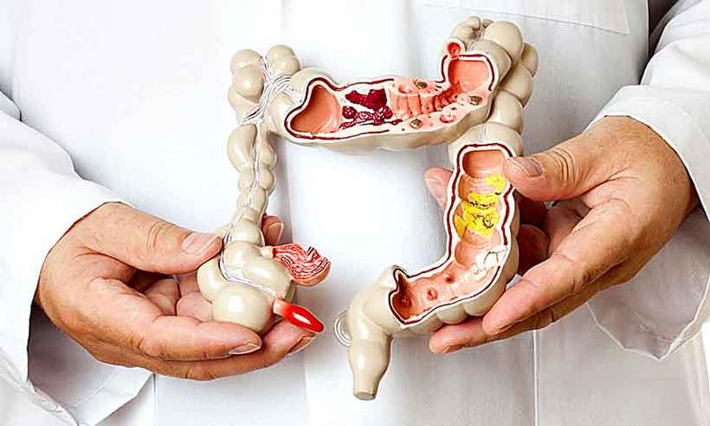 Pesquisa do Inca alerta para novos casos de câncer colorretal no Brasil neste ano: 20.540 em homens e 20.470 em mulheres (foto: Sociedade Brasileira de Cancerologia/Divulgação) Pesquisa do Inca alerta para novos casos de câncer colorretal no Brasil neste ano: 20.540 em homens e 20.470 em mulheres (foto: Sociedade Brasileira de Cancerologia/Divulgação)