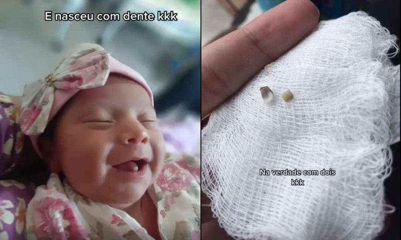 Os dentinhos de Ariella foram arrancados nos primeiros dias de vida(foto: Reprodução / redes sociais) foto de Ariella com o dentinho e os dentes em uma gaze