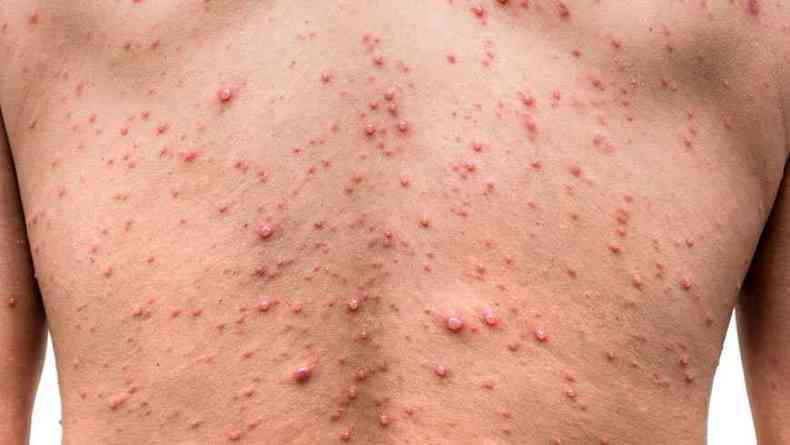 Estudos apontam aumento nos casos de varicela, a popular catapora, entre os meses de setembro e outubro(foto: reproduo de internet)