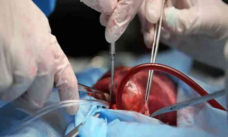 Cirurgia de transplante de corao
