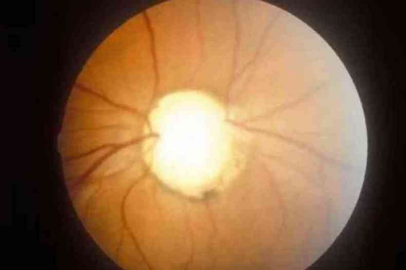 Olho com glaucoma