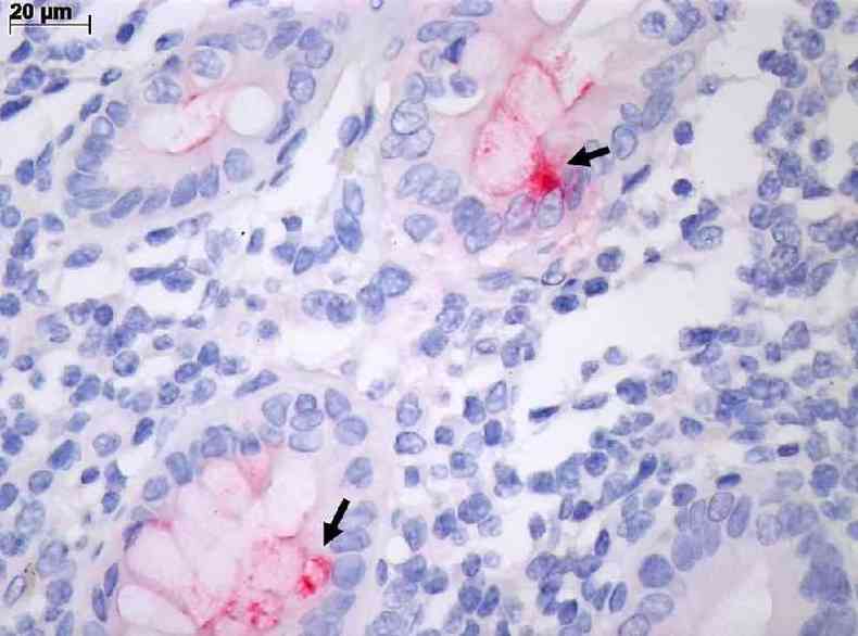 Intestino com inflamao pela covid-19, observado pelo microscpio comum. A colorao vermelha (seta) marca a infeco de clula intestinal pelo vrus SARS-CoV-2.