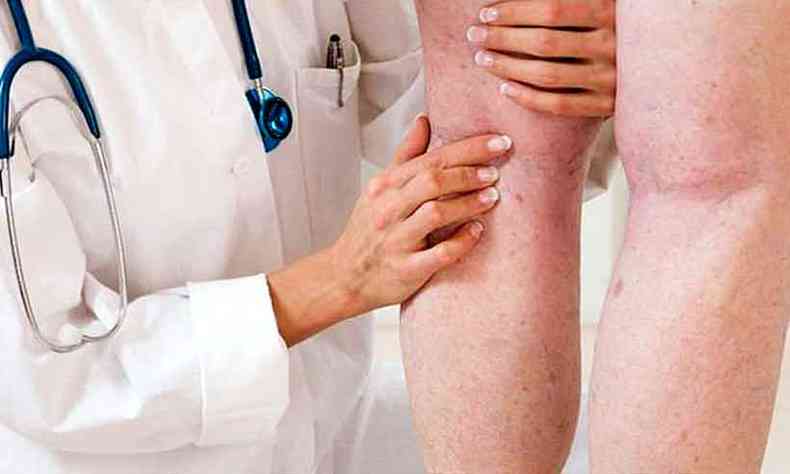Dor na perna, principalmente na panturrilha, inchao, calor, sensibilidade e vermelhido esto entre os sintomas da trombose(foto: ocirurgiaovascular.com.br/Reproduo)