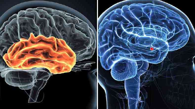 Duas imagens do crebro. A esquerda ressalta La de la izquierda resalta o crtex auditivo; o da direita destaca a amgdala
