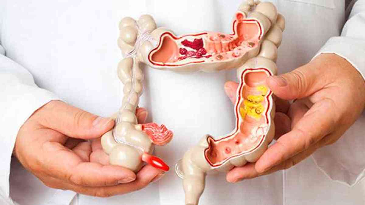 O Câncer colorretal pode ser uma das consequências do consumo exacerbado desses produtos (Foto Reprodução/Internet)