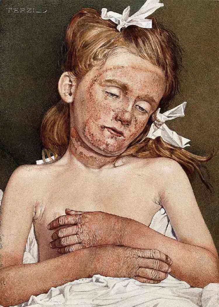 'Uma menina na casa de repouso de Londres sofrendo de pelagra crnica', aquarela de A.J.E. Terci, 1925