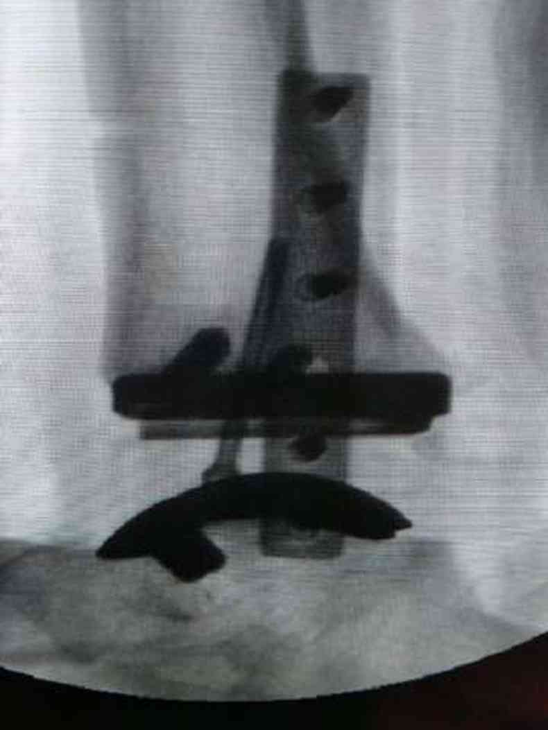 Detalhe da prtese colocada em paciente mineiro(foto: Divulgao)