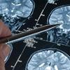 Medicamento experimental contra Alzheimer tem resultados 'históricos'
