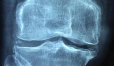 No deixe a osteoporose te pegar de surpresa: tenha diagnstico precoce