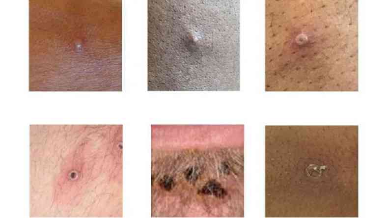 Alguns exemplos de leses sugestivas de monkeypox
