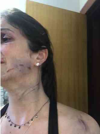 Marina Schaun mostra as marcas no rosto e no corpo
