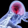 Cresce número de brasileiros mortos por acidente vascular cerebral