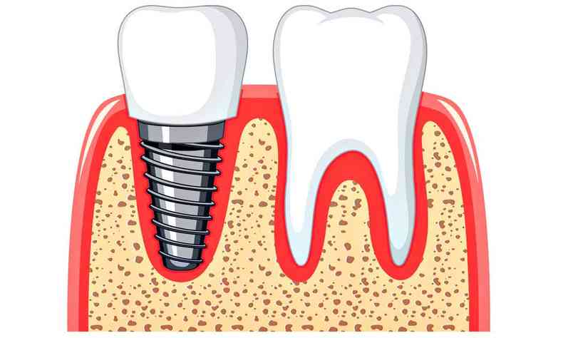 Ilustração de implante dentário 