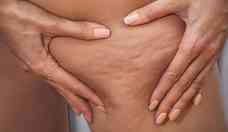 Celulite piora com alimentao inflamatria; veja como prevenir