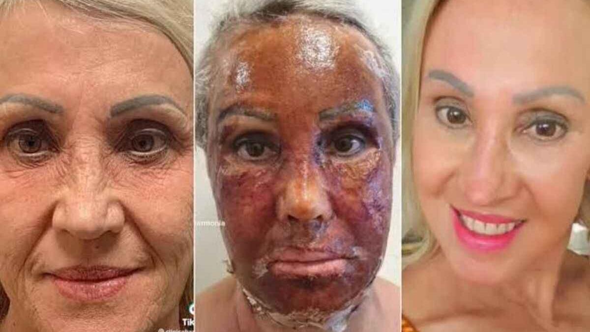 Viralizou nas redes: entenda a técnica que fez mulher 'trocar de pele' -  Saúde - Estado de Minas