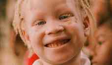 Dia Internacional da Conscientizao sobre o Albinismo: saiba dos cuidados