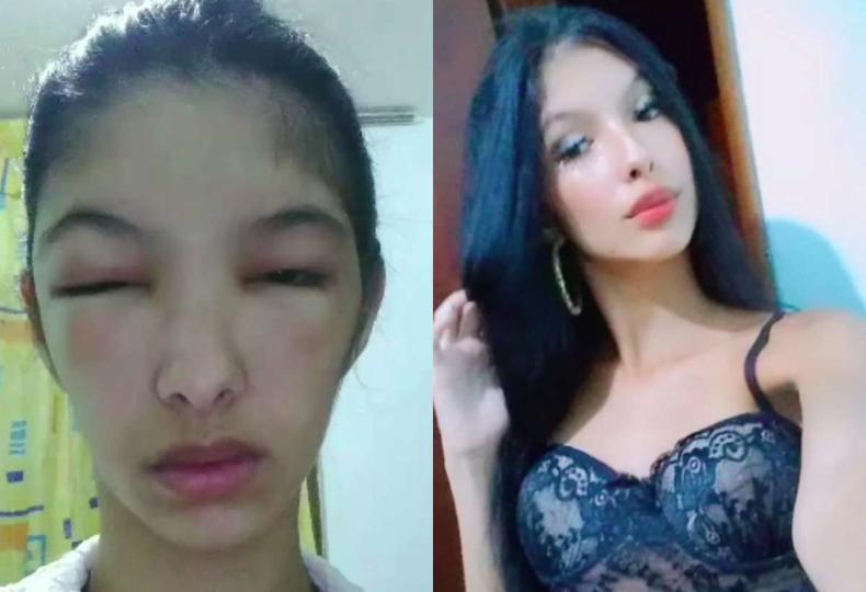 Montagem de fotos da moa com a cara inchada e cara normal