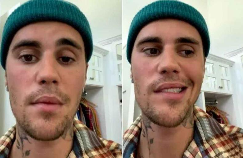 Justin Bieber via Instagram mostrando sua face paralisada por causa da Sndroma de Ramsay Hunt