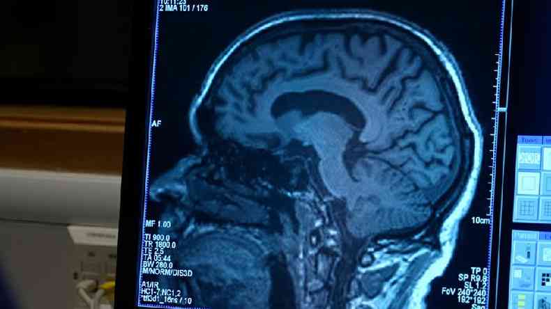 Na ltima dcada, mais de cem tratamentos potenciais para Alzheimer fracassaram(foto: BBC)