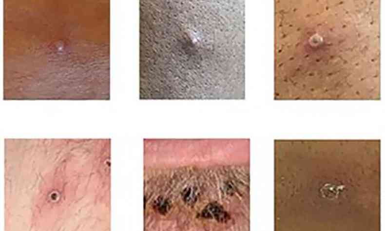 exemplo de várias lesões na pele