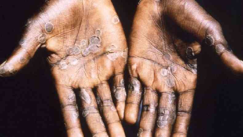Mãos com varíola dos macacos