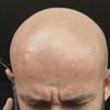 Minoxidil não é indicado para queda de cabelo pós-COVID
