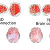 Estudo propõe uso de inteligência artificial no diagnóstico do autismo