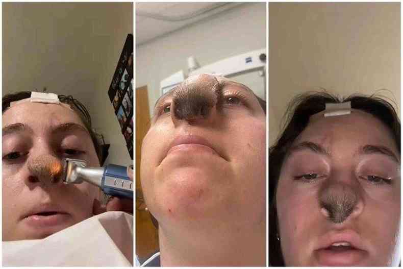 Mulher fica com nariz peludo após ataque de cão 