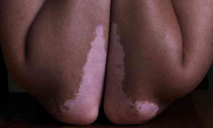 cotovelos com vitiligo