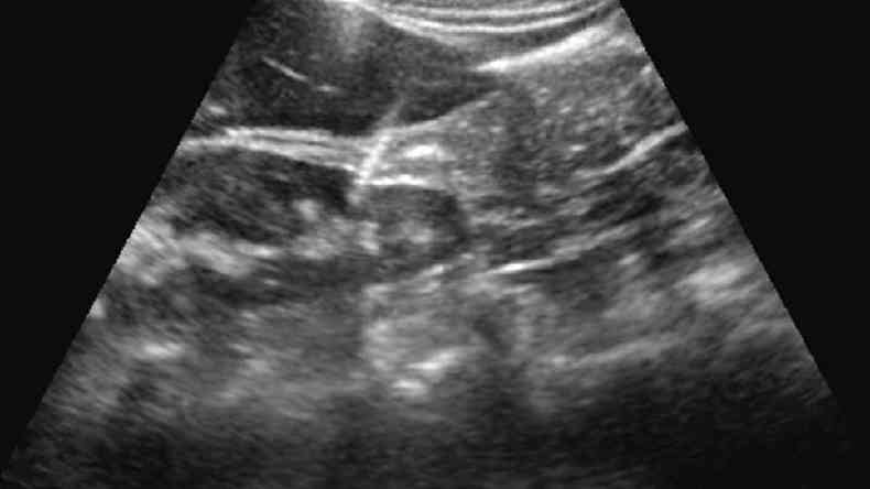 As imagens produzidas por ultrassonografia permitem que a equipe veja a posio da agulha dentro do corpo(foto: FMUSP)