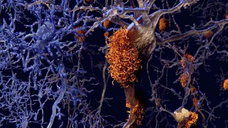 Pelo que se sabe at o momento, a doena se inicia com a deposio da protena beta-amiloide (representada na cor laranja na ilustrao) do lado de fora dos neurnios(foto: Getty Images)