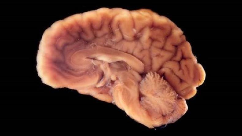 O cérebro usa até 25% do oxigênio do nosso corpo. Por isso, ele é o primeiro órgão a morrer quando paramos de respirar.(foto: Getty Images) cérebro
