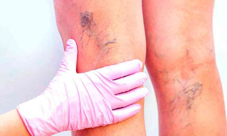 Foto mostra mão com luvas examinando varizes nas pernas de mulher 
