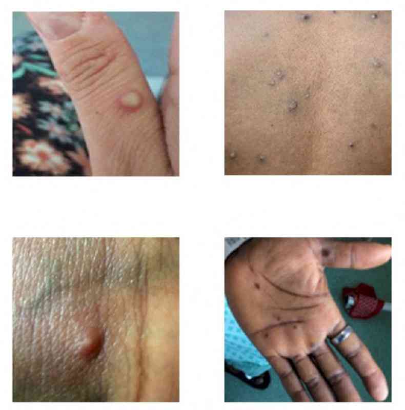 Lesões características do monkeypox