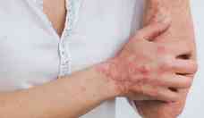 Dermatite atpica: dermatologistas alertam pais sobre a doena