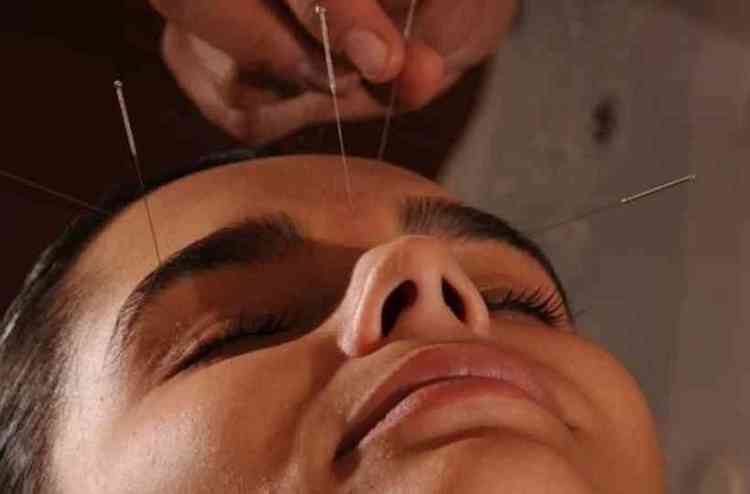 Mulher em sesso de acupuntura 